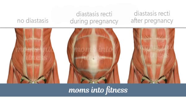 Diastasis Recti Do’s & Don’ts during Pregnancy - Two Specific Exercises