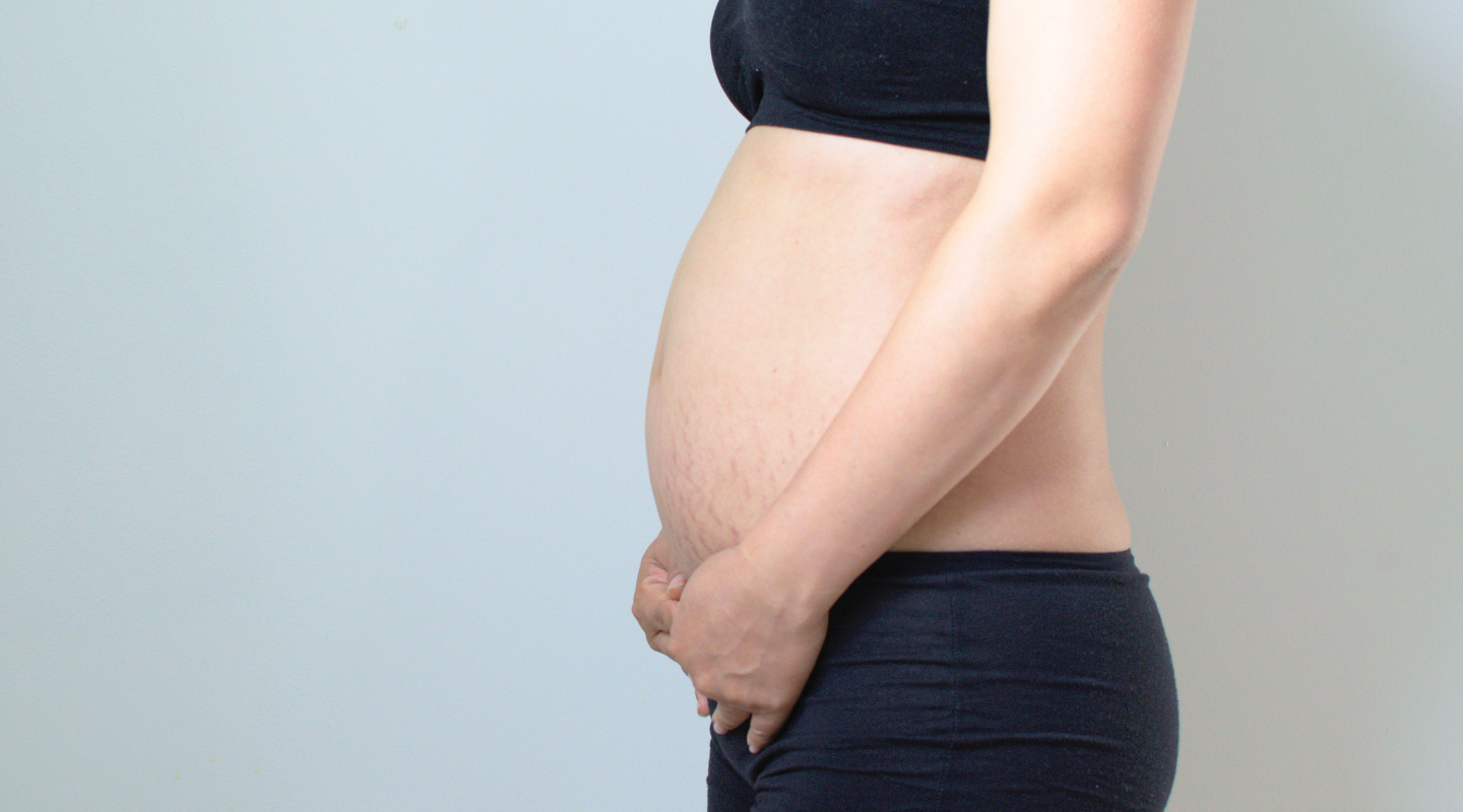 Prevent Stretch Marks During Pregnancy - Stretch Marks Diet - Moms