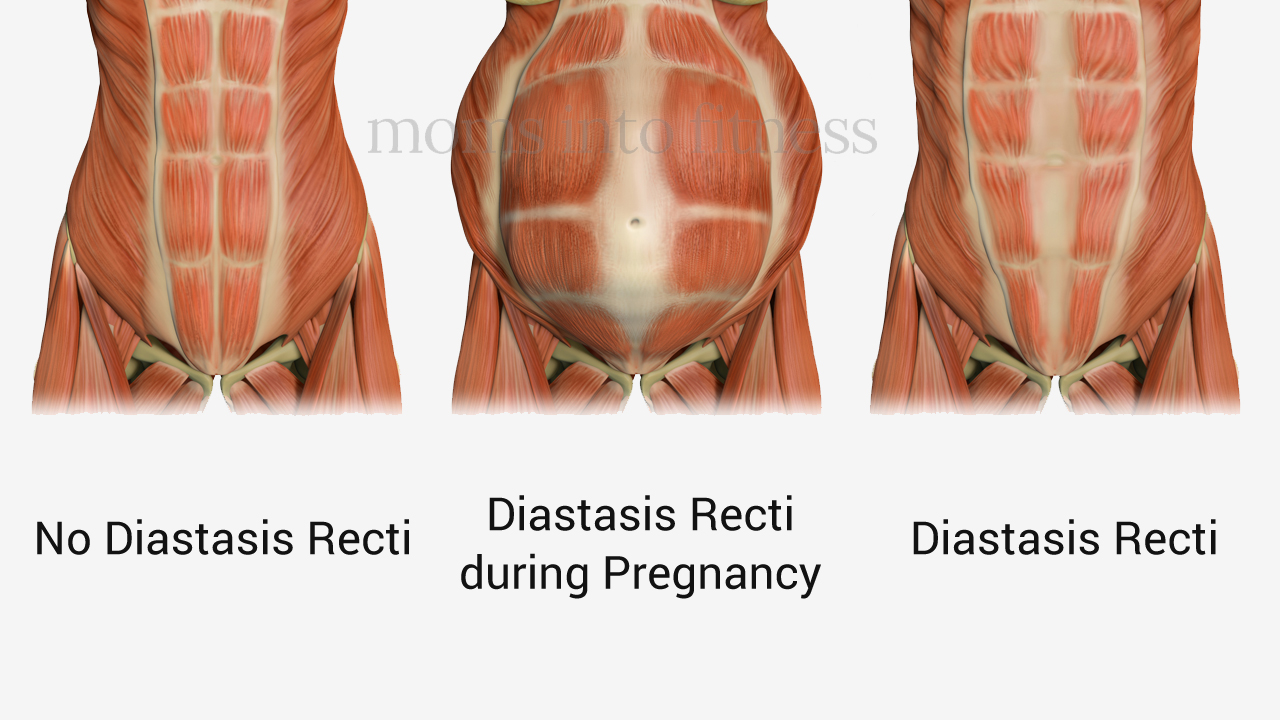 Everything You Need to Know About Diastasis Recti